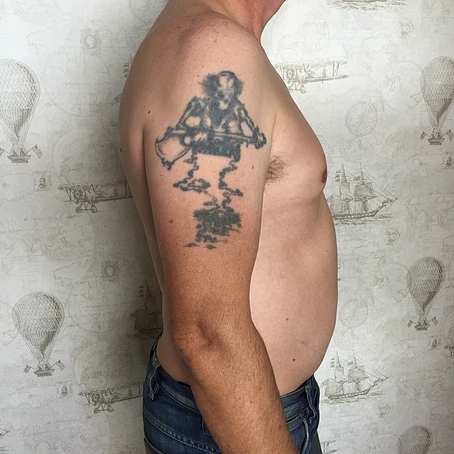 Top Auckland laser tattoo removal with Winz Grant support.